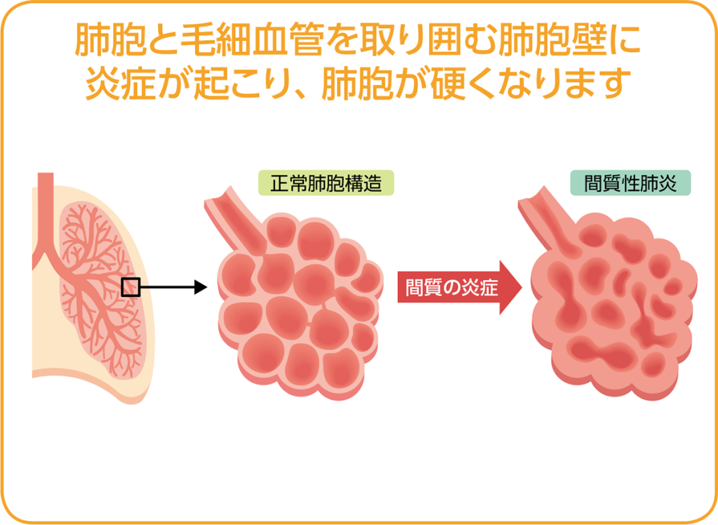 irAEナビ「副作用から調べる」の図表：肺胞壁に炎症が起こり、肺胞が硬くなるプロセス