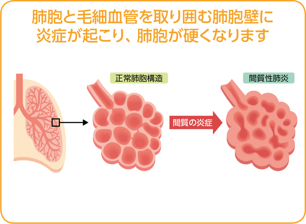 irAEナビ「副作用から調べる」の図表:肺胞壁に炎症が起こり、肺胞が硬くなるプロセス
