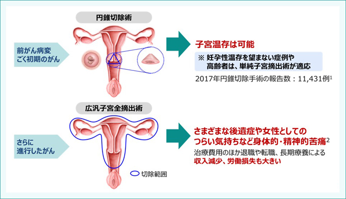 子宮頸がんの主な手術