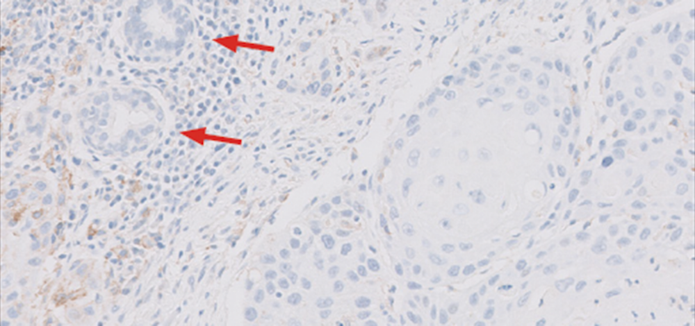 PD L1 IHC C3 pharmDxダコを用いたPD L1染色像   Biomarker