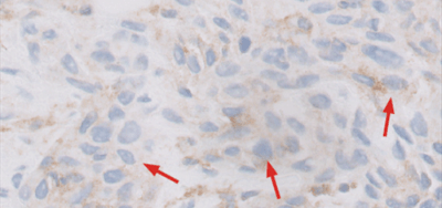 細胞質のみ染色された腫瘍細胞