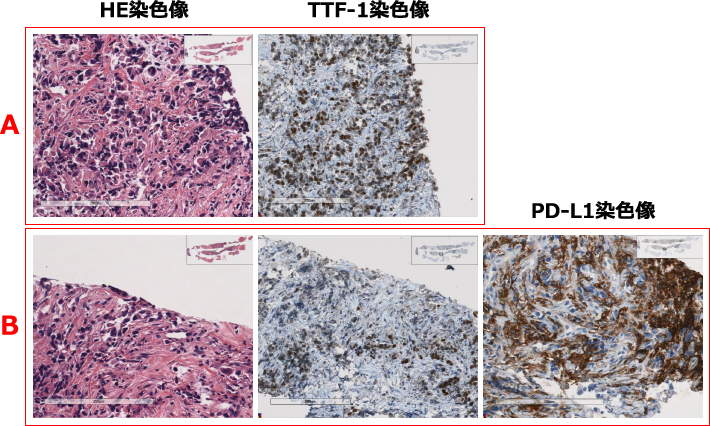 HE染色像　TTF-1染色像　PD-L1染色像