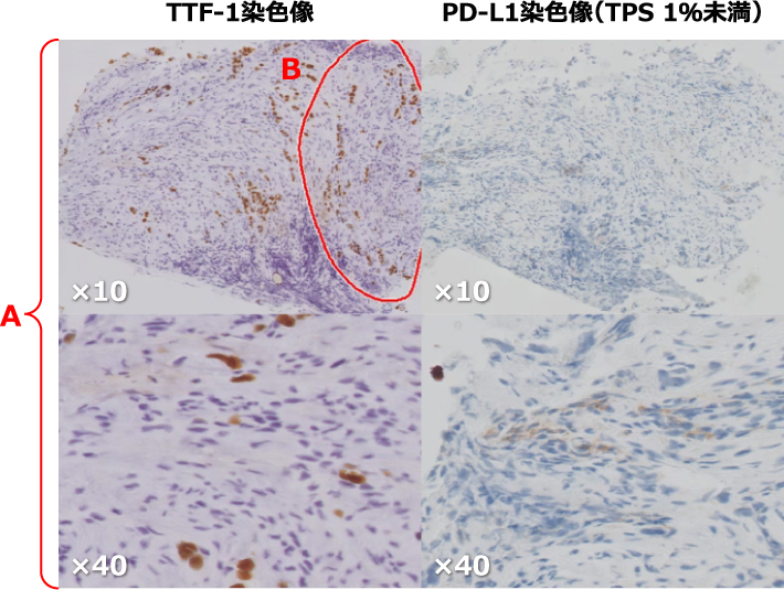 TTF-1染色像　PD-L1染色像(TPS 1%未満)
