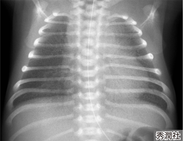 一過性頻呼吸のある新生児の今後の見通しはどうなりますか?