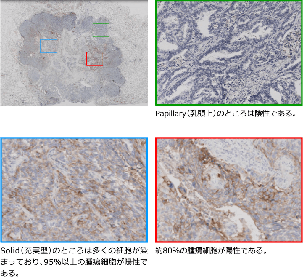 PD-L1染色像