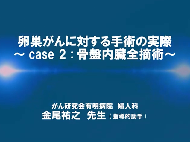 【卵巣癌】卵巣がんに対する手術の実際 〜case 2：骨盤内臓全摘術〜