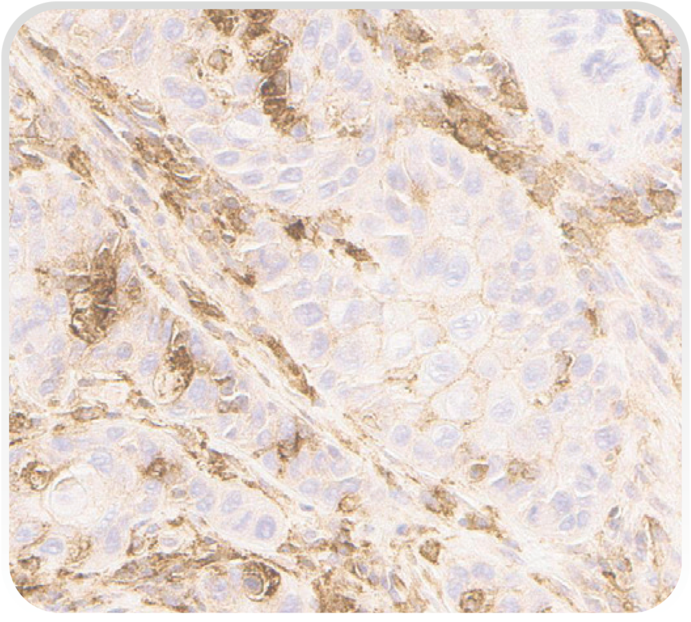発色領域を20×の対物レンズを用いて拡大し、陽性細胞と陰性細胞を、腫瘍細胞と免疫細胞それぞれについて同定し、その数を記録する。