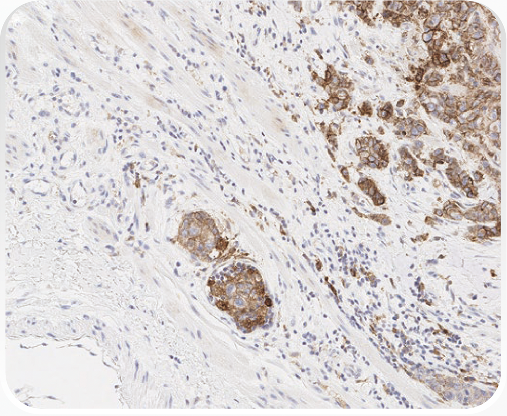 発色領域を20×の対物レンズを用いて拡大し、陽性細胞と陰性細胞を、腫瘍細胞と免疫細胞それぞれについて同定し、その数を記録する。