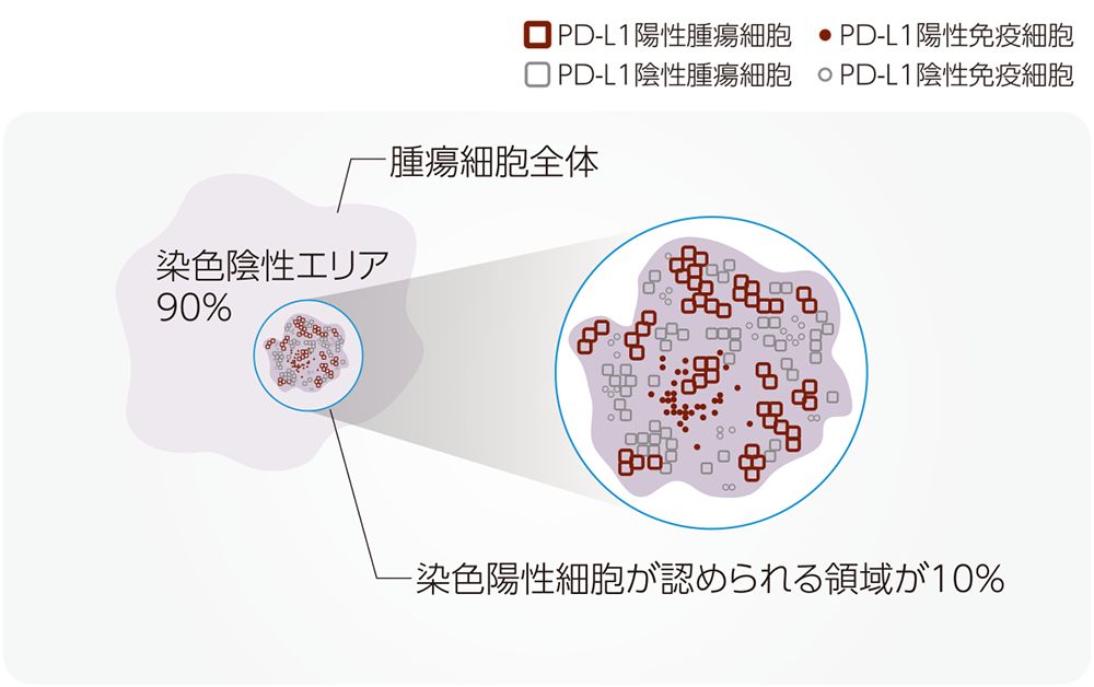 陽性細胞の分布が限局しているパターン