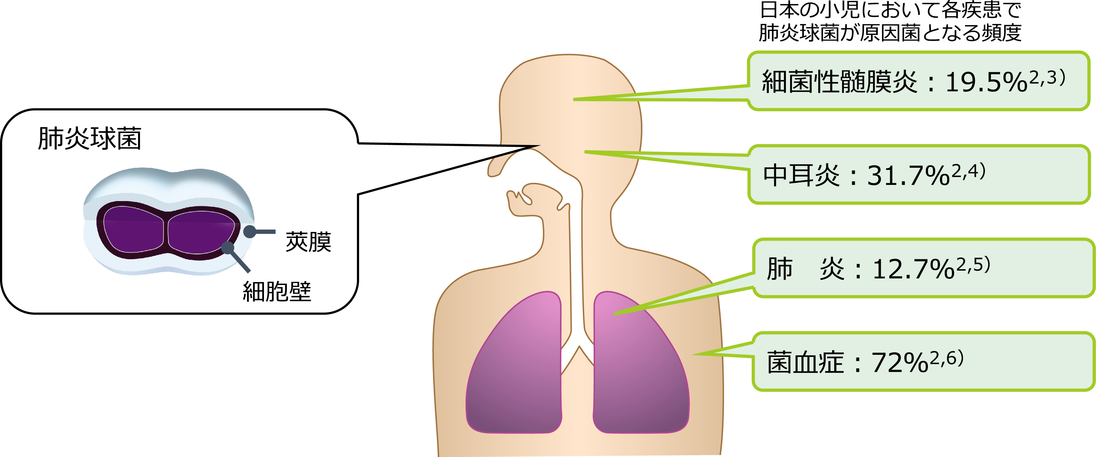 肺炎球菌感染症とは