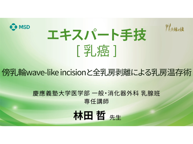【乳癌】エキスパート手技 傍乳輪wave-like incisionと全乳房剥離による乳房温存術