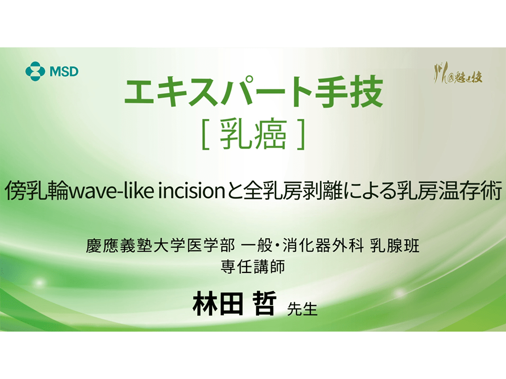 【乳癌】エキスパート手技 傍乳輪wave-like incisionと全乳房剥離による乳房温存術