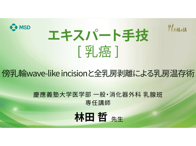 【乳癌】エキスパート⼿技 傍乳輪wave-like incisionと全乳房剥離による乳房温存術