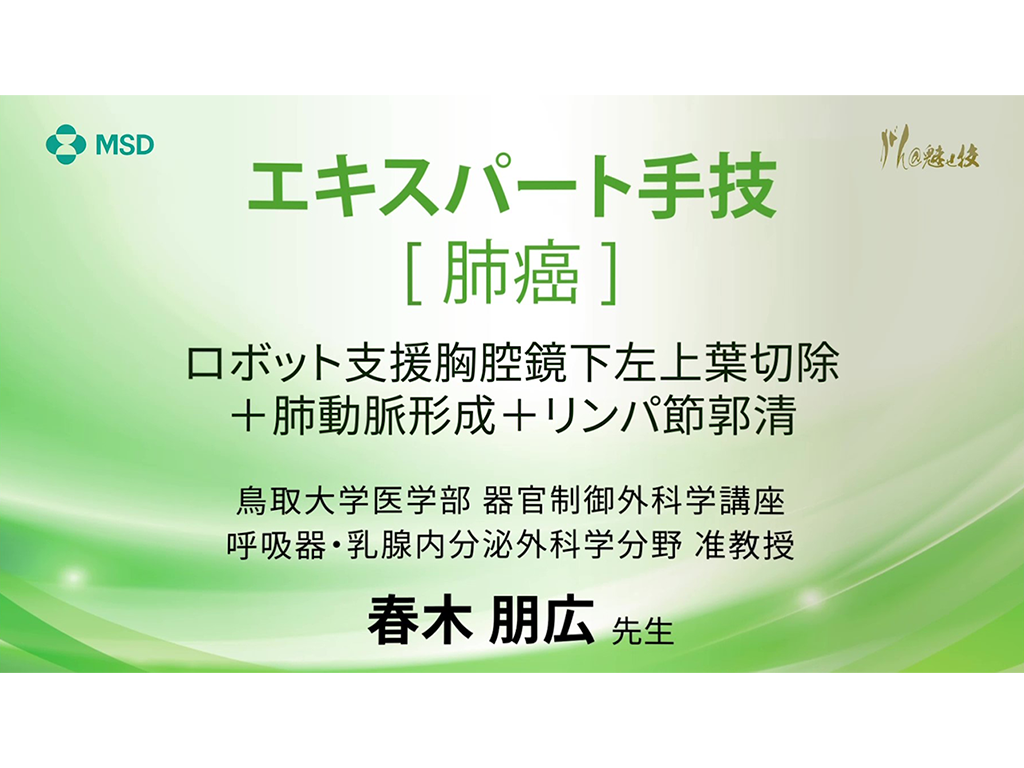 【肺癌】エキスパート⼿技 ロボット⽀援胸腔鏡下左上葉切除＋肺動脈形成＋リンパ節郭清