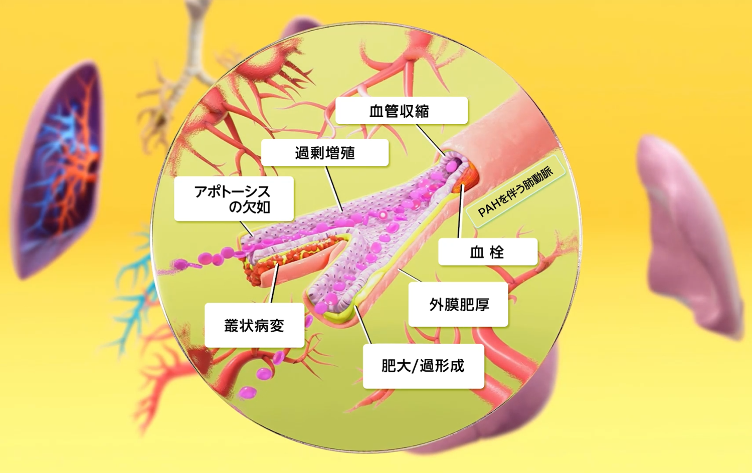 PAHの病態〜肺動脈のリモデリング～ | MSD Connect