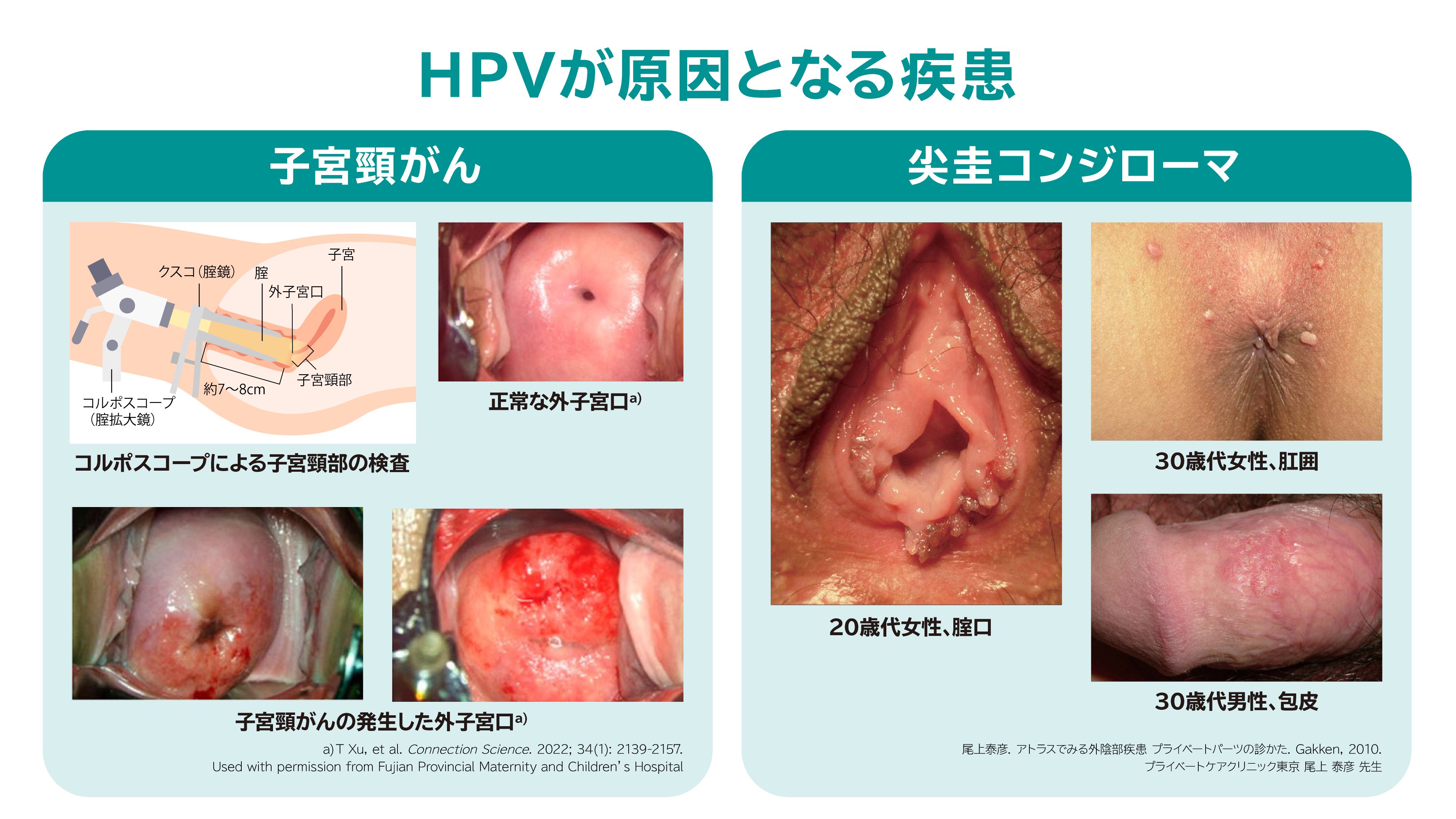 HPVが原因となる疾患
