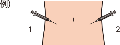 注射部位の変更例
