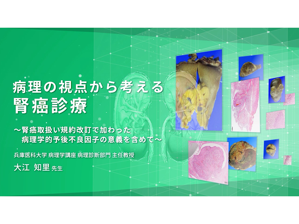 【腎細胞癌】病理の視点から考える腎癌診療 〜腎癌取扱い規約改訂で加わった病理学的予後不良因⼦の意義を含めて〜