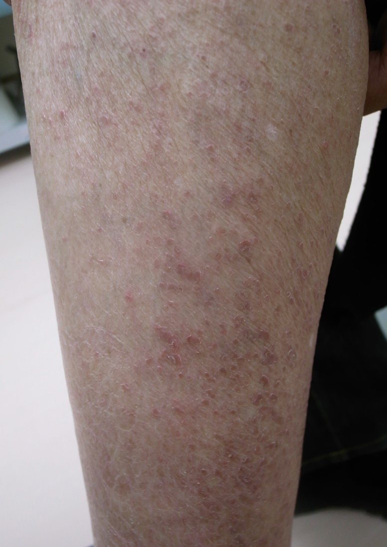■症例写真1：ICI単剤投与中に下肢に生じた乾燥と落屑を伴う紅斑