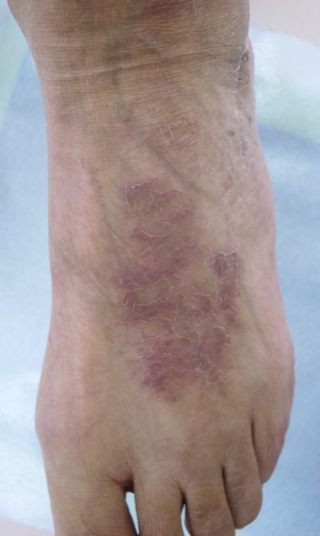 ■症例写真1：ICI単剤投与中に下肢に生じた乾燥と落屑を伴う紅斑