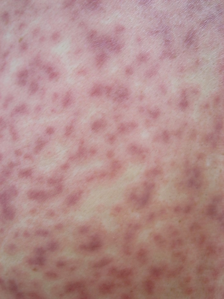 ■症例写真2：ICI単剤投与中に生じた体幹部の丘疹と口唇の腫脹