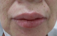 ■症例写真2：ICI単剤投与中に生じた体幹部の丘疹と口唇の腫脹