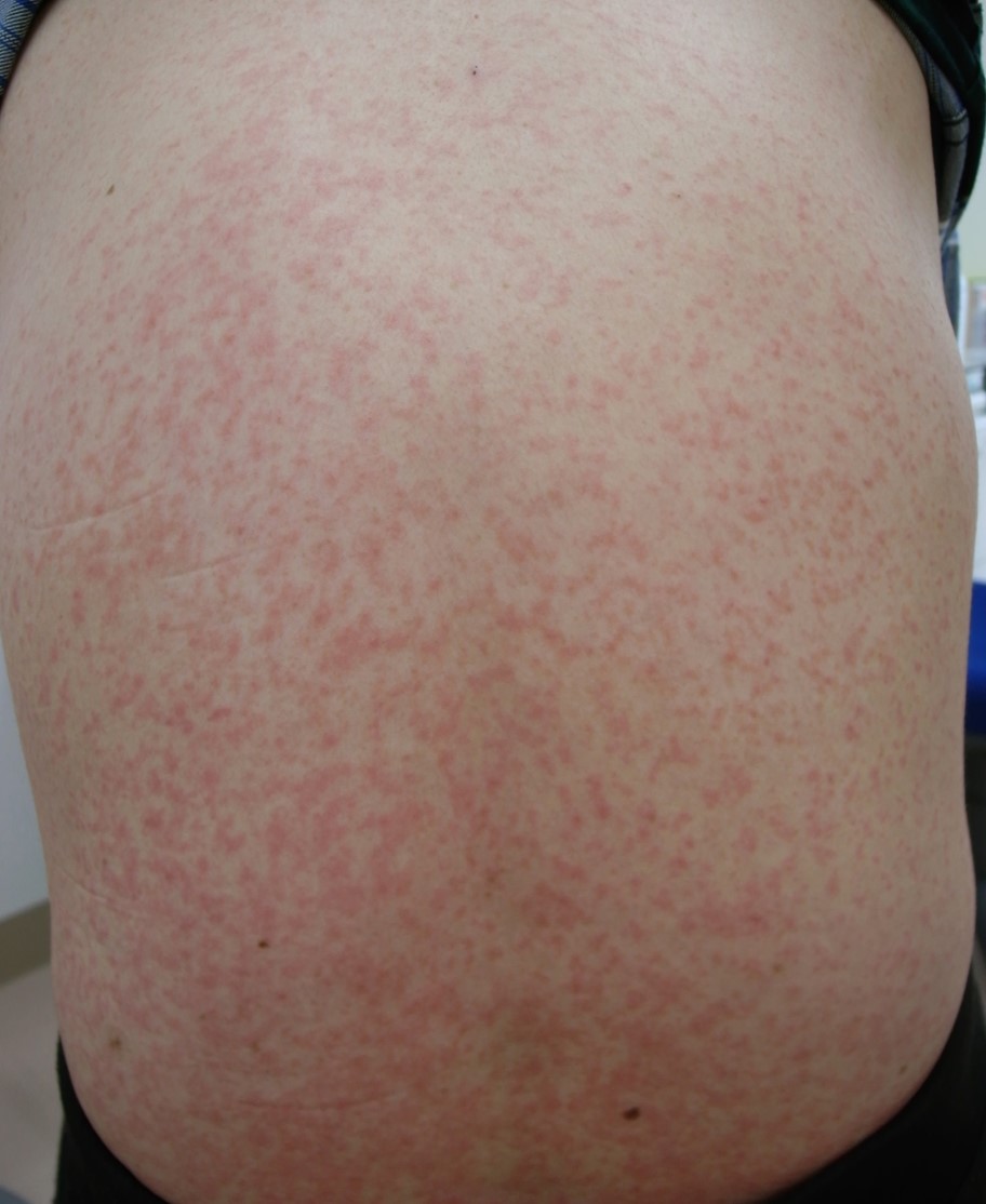 ■症例写真3：全身性の皮疹と紅斑を伴う症例