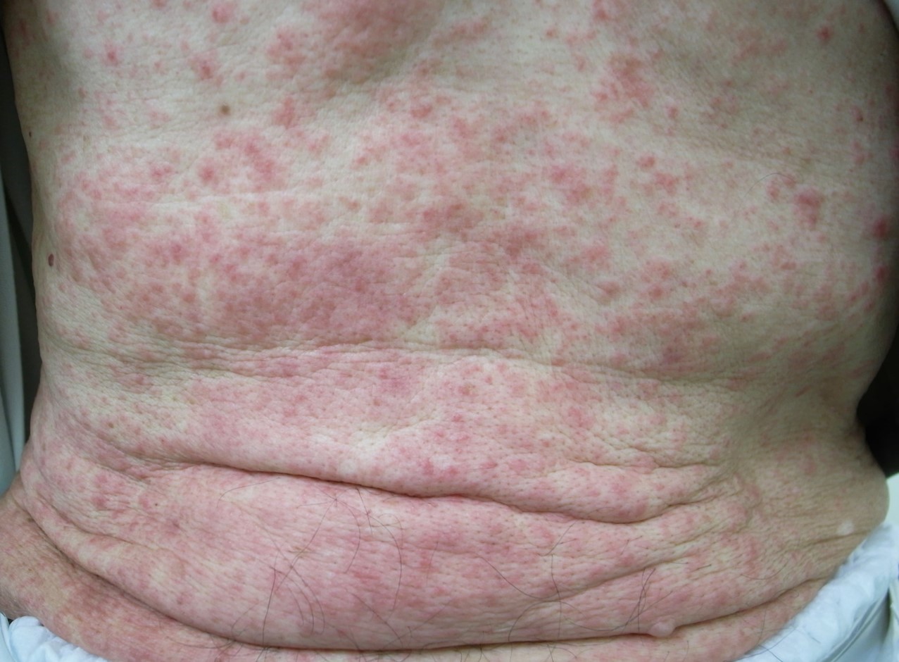 ■症例写真3:全身性の皮疹と紅斑を伴う症例