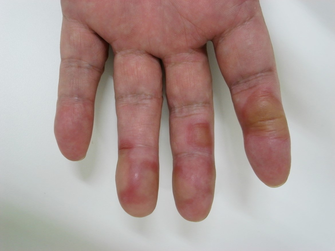 ■症例写真4　手指に生じたびらん、浮腫性紅斑の症例