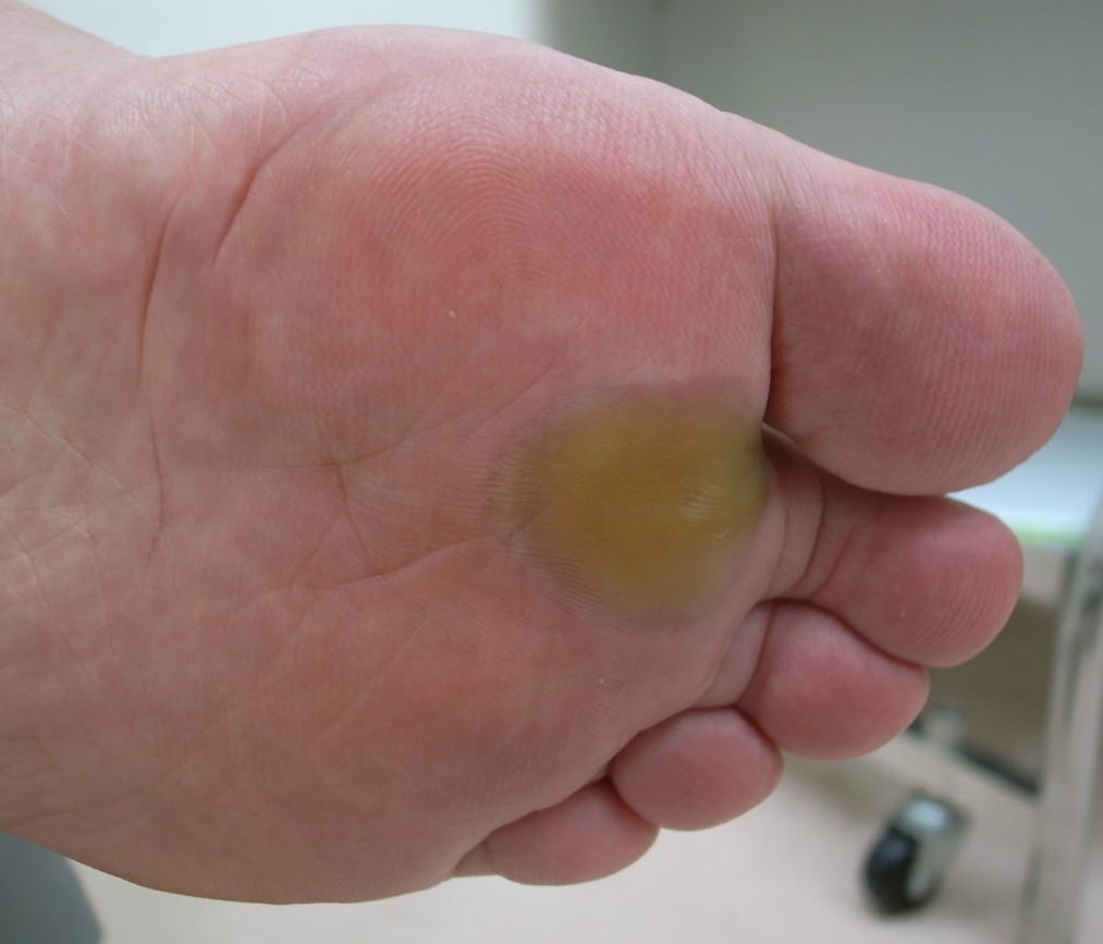 ■症例写真4　手指に生じたびらん、浮腫性紅斑の症例