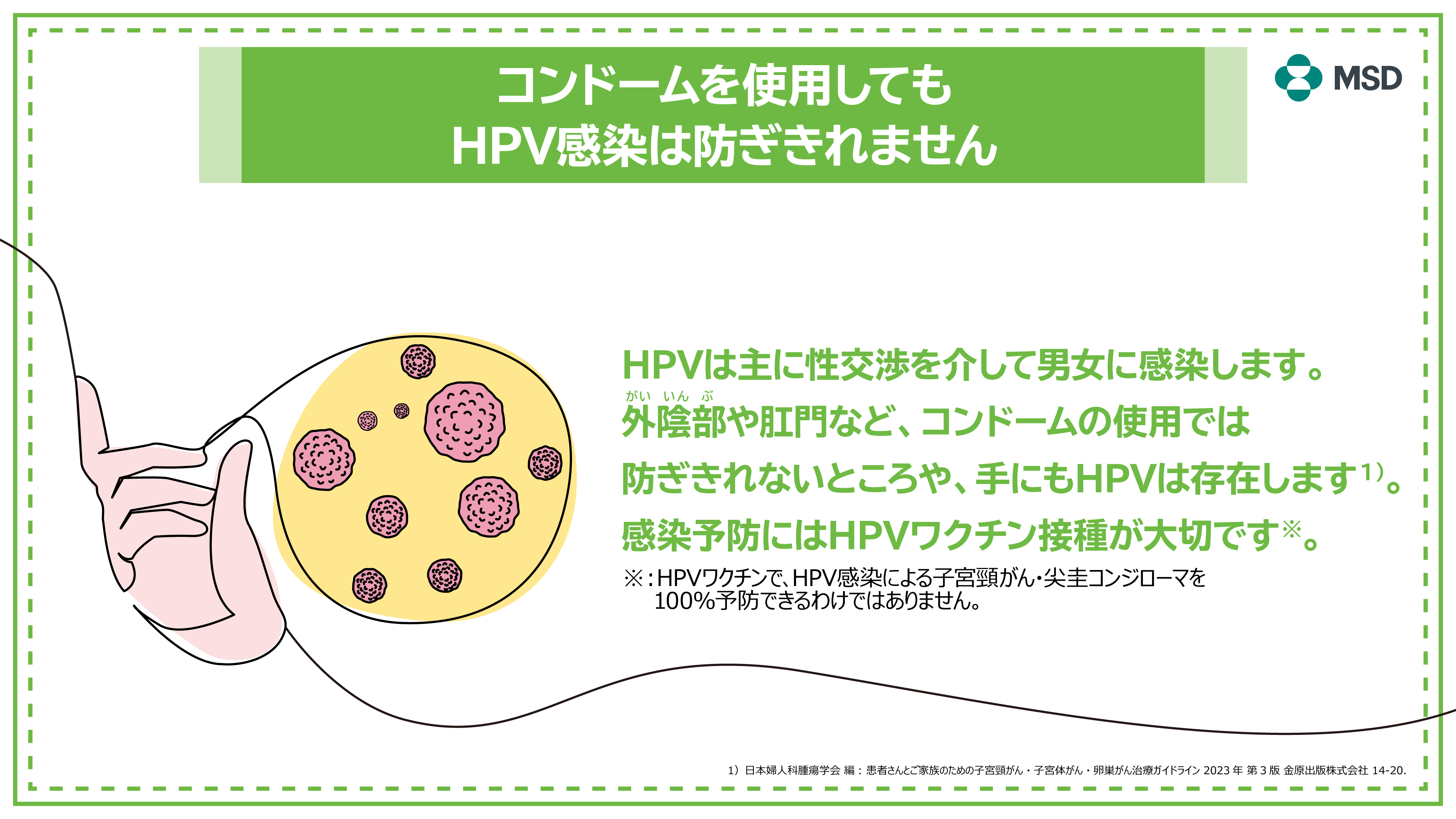 コンドームを使用してもHPV感染は防ぎきれません