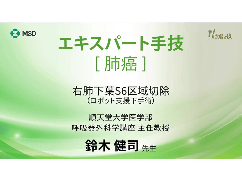【肺癌】エキスパート手技 右肺下葉S6区域切除（ロボット⽀援下手術）