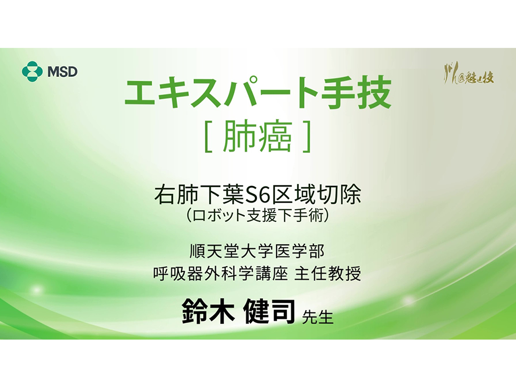 【肺癌】エキスパート手技 右肺下葉S6区域切除（ロボット⽀援下手術）