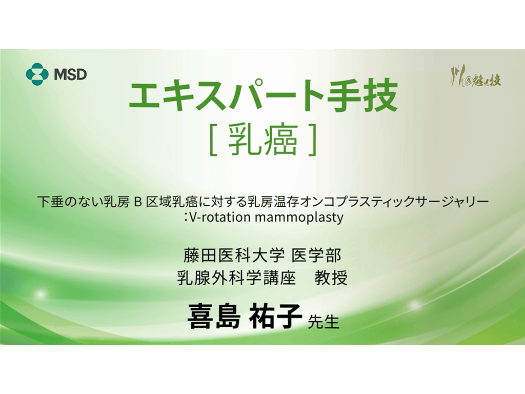 【乳癌】エキスパート手技 下垂のない乳房B区域乳癌に対する乳房温存オンコプラスティックサージャリー：V-rotation mammoplasty